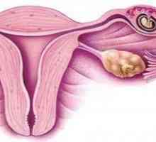 Identifikace raných fázích mimoděložního těhotenství: příznaky a stanovení diagnózy.