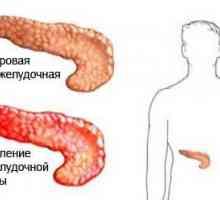 Zjišťování příčin pankreatitida