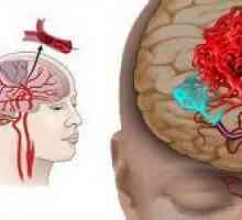 Mozek onemocnění cévního původu