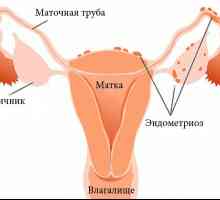 Proč je přiřazen fyzikální terapii endometriózy