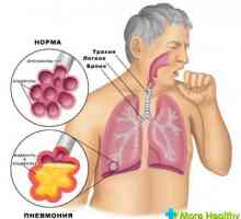 Městnavé pneumonie, co to je a jak ji léčit