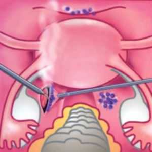 Adenomyóza a endometrióza: jak se odlišit?