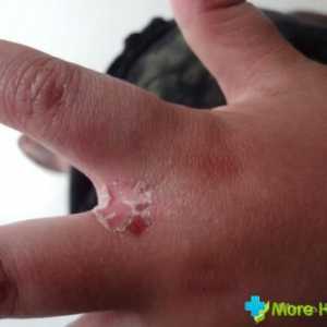 Alergický na pokožku rukou: příznaky a léčba