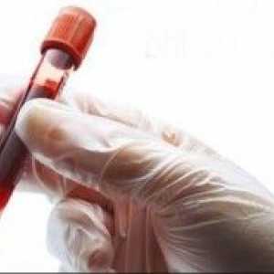 Krevní test pro ESR Westergren: co je to? Jsou-li zvýšeny pravidla, co to znamená a jaké jsou…