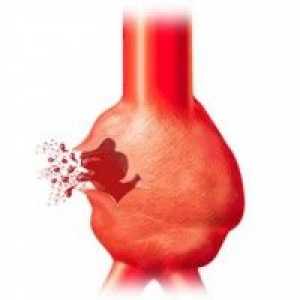Aneurysma břišní aorty: symptomy, diagnostika, léčba