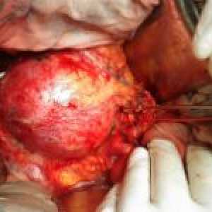 Aorty, její typy a léčba
