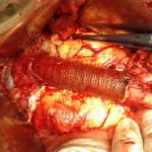 Aneurysma aorty (mezera) a její léčba