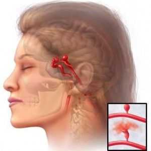 Aneurysma mozkových cév: příčiny, symptomy, efekty, chirurgie