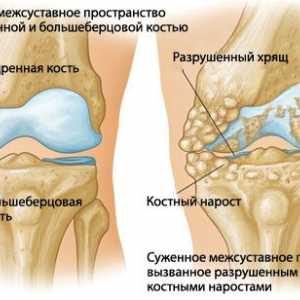 Artritida kolenního kloubu