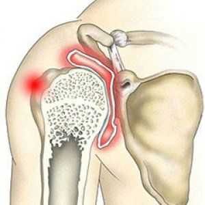 Artritida ramenního kloubu