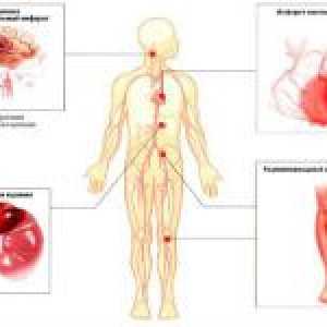 Aterosklerotické léze tepen (ateroskleróza)