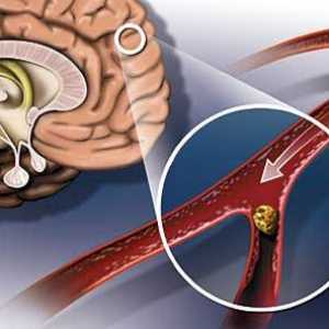 Ateroskleróza hlava: její příčiny, příznaky a léčba