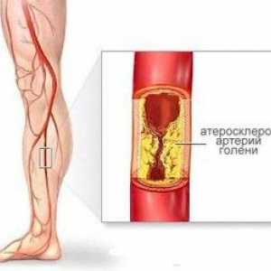 Ateroskleróza dolních končetin