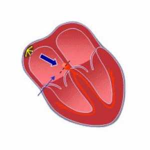 Atrioventrikulární blok (AV) srdeční: příčiny, rozsah, příznaky, diagnostika, léčba