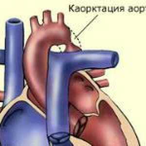 Koarktace aorty a její léčba