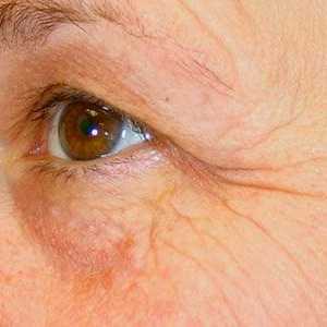 Botox na kůži kolem očí - recenze a popis