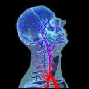 Mozková ischemie a její důsledky