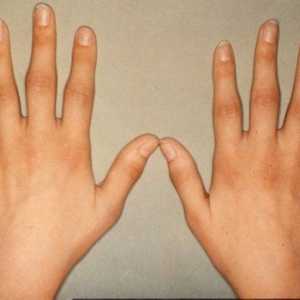 Běžné příčiny otoky prstů