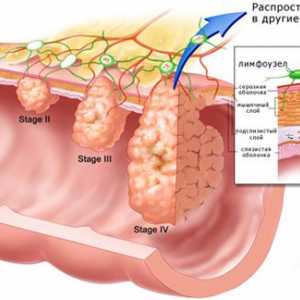 Typy, příznaky a léčba nádorů žaludku
