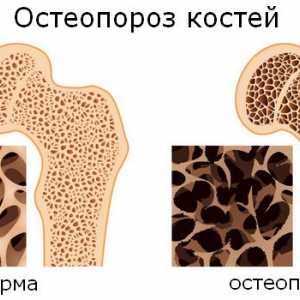 Jaký druh osteoporózy kostní choroby