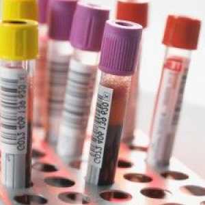 Co je krevní test ASAT a kdy musíme brát