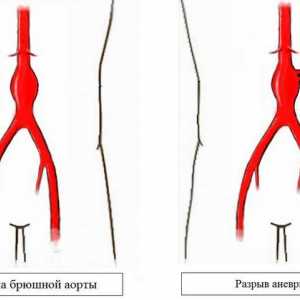 Co je aneurysma břišní aorty?