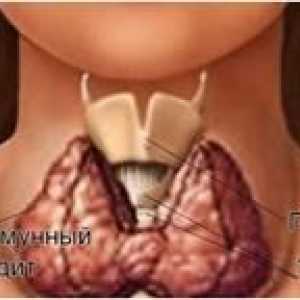 Co je Hashimotova tyroiditida štítné žlázy, cimptomy a léčení nemocí