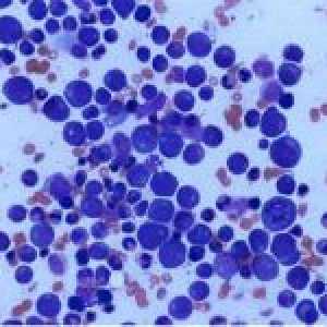 Leukocytóza (zvýšené množství bílých krvinek v krvi): normy nebo patologii?