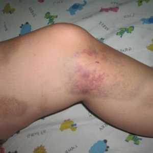 Co je zranění nohy, a zejména její léčba