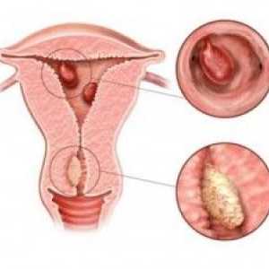 Co je glandulocystica hyperplazie endometria