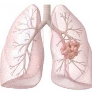 Diagnostika a léčba rakoviny plic
