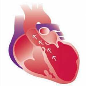 Dilatace srdečních komor, aorta - podmínky, příznaky, diagnostika, léčba