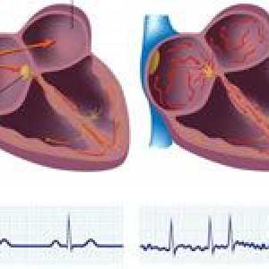 Síňová (blikající) srdeční arytmie