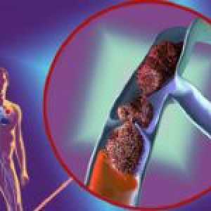Hluboká žilní trombóza a její léčba
