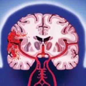 Hemoragické mozkové mrtvice: druhy, příznaky, diagnóza, léčba, rizikové faktory