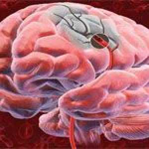 Důsledky ischemické cévní mozkové příhody mozkové