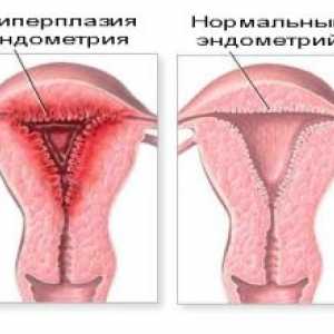 Hyperplazie endometria: léčba léky a lidových prostředků