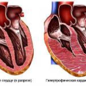 Hypertrofické kardiomyopatie u dětí a dospělých