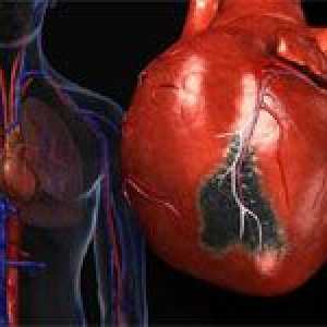 Hlavními důvody pro rozsáhlý infarkt myokardu