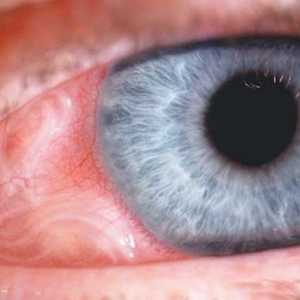 Oční larvální toxokaróza: symptomy, diagnostika, léčba
