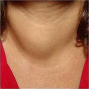 Hashimotova tyroiditida s výsledkem hypotyreózy: příznaky a léčba