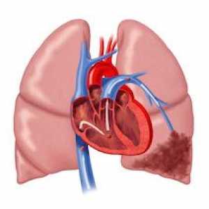 Plicní myokardu: příčiny, příznaky, jak se chovat, účinky