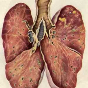 Inkubační doba tuberkulózy, jeho diagnóze a léčbě