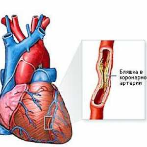 Ischemická choroba srdeční (ICHS)