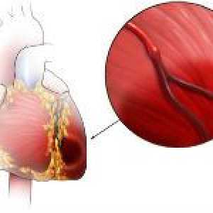 Ischemická kardiomyopatie