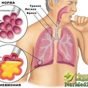 Léčit zápal plic lidových opravné prostředky doma