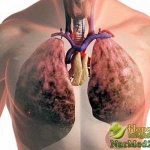 Účinná léčba plicní fibrózou lidových prostředků
