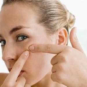 Efektivní a levná akné mast na obličej - na co se zaměřit?