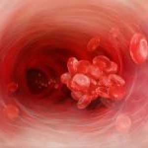 Cévní embolie - co to je?