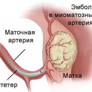 Embolizace děložních myomů